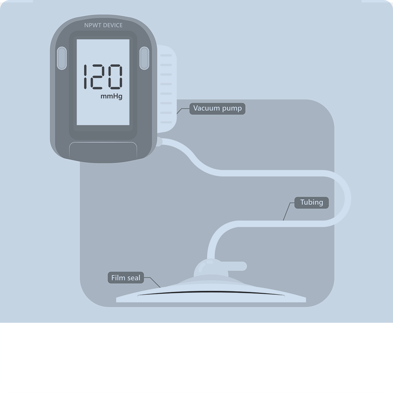 NWT-Negative Wound Therapy
